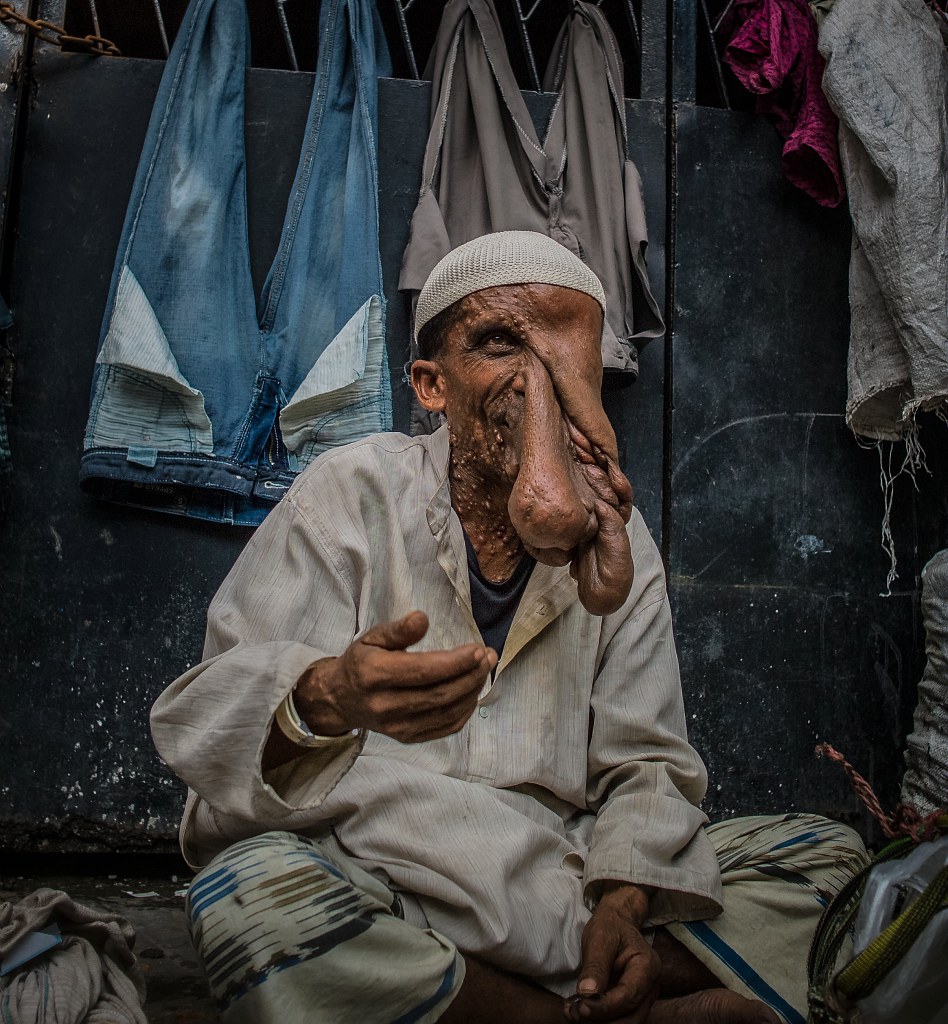 Maladie De L'homme De Pierre Photos 27/08/2013 - Inde / Bengale / Kolkata